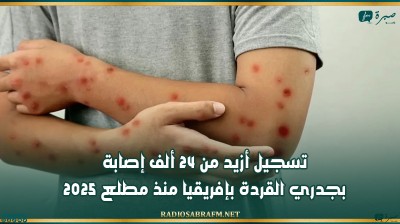 تسجيل أزيد من 24 ألف إصابة بجدري القردة بإفريقيا منذ مطلع 2025