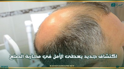 اكتشاف جديد يعطى الأمل في محاربة الصلع