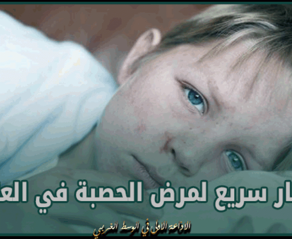 منظمة الصحة العالمية تُعرب عن قلقلها من الإنتشار السريع لمرض الحصبة في العالم