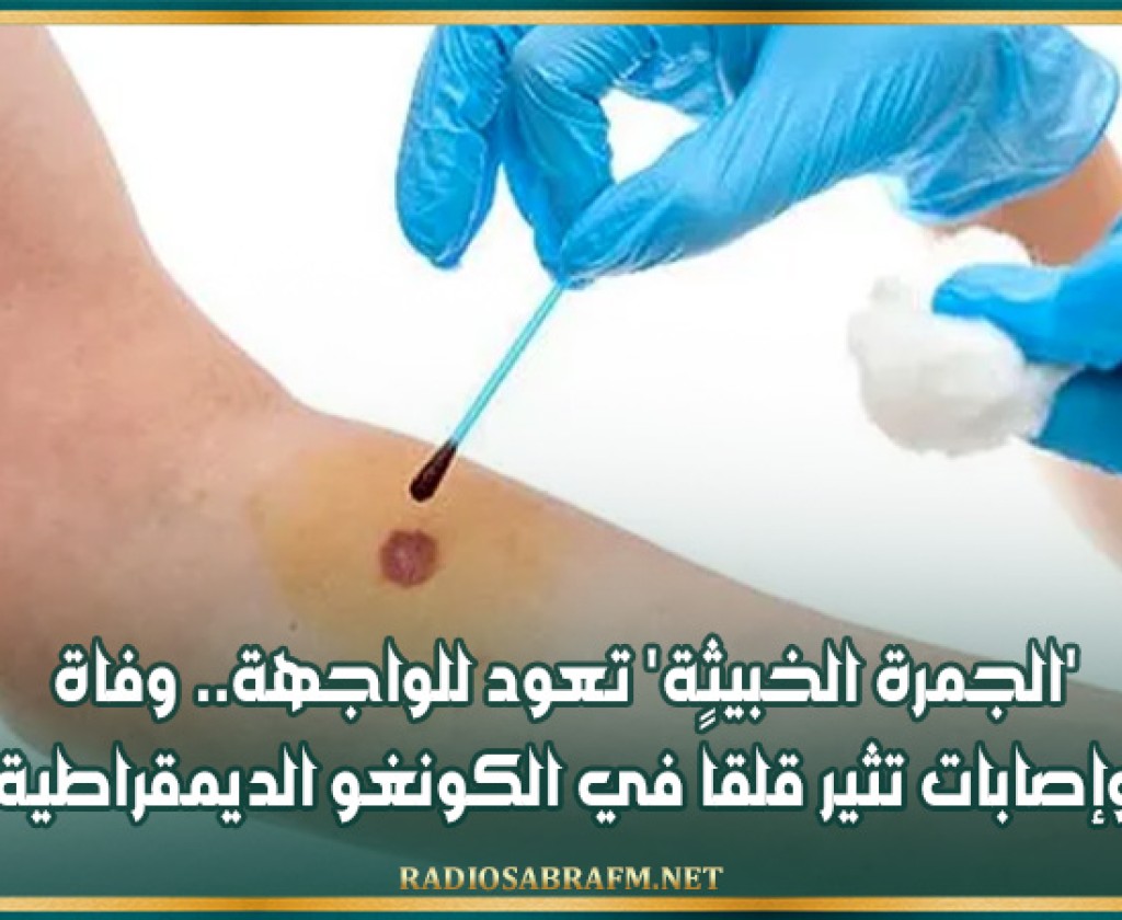 'الجمرة الخبيثة' تعود للواجهة.. وفاة وإصابات تثير قلقاً في الكونغو الديمقراطية