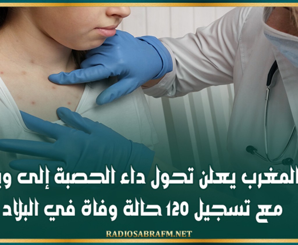 المغرب يعلن تحول داء الحصبة إلى وباء مع تسجيل 120 حالة وفاة في البلاد