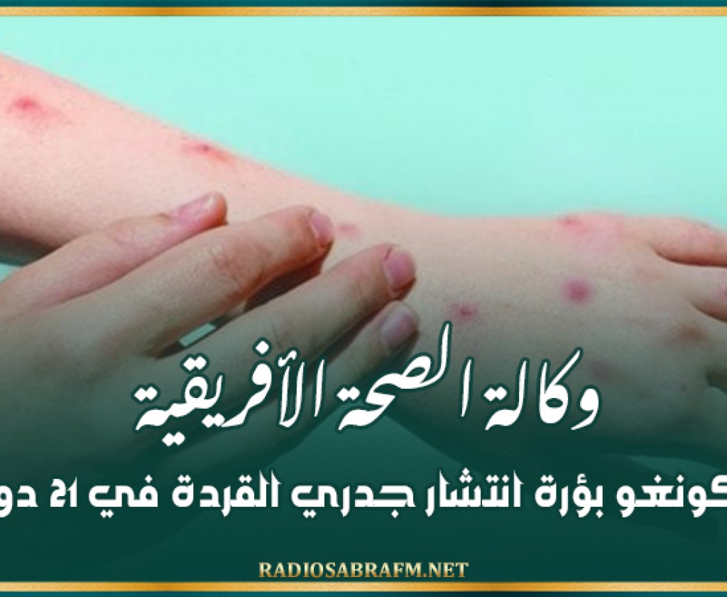 وكالة الصحة الأفريقية: الكونغو بؤرة انتشار جدري القردة في 21 دولة