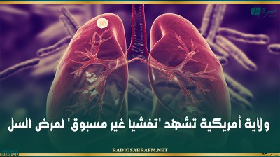 ولاية أمريكية تشهد 'تفشيا غير مسبوق' لمرض السل