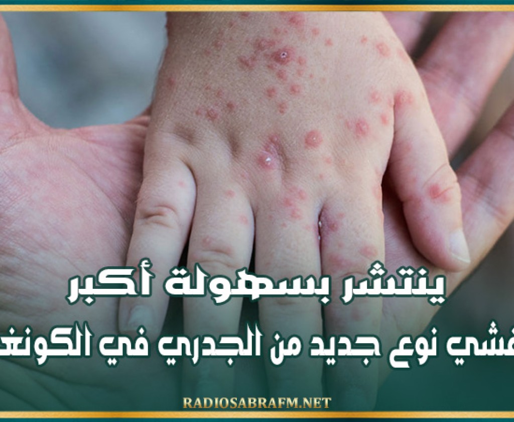 ينتشر بسهولة أكبر.. تفشي نوع جديد من الجدري في الكونغو