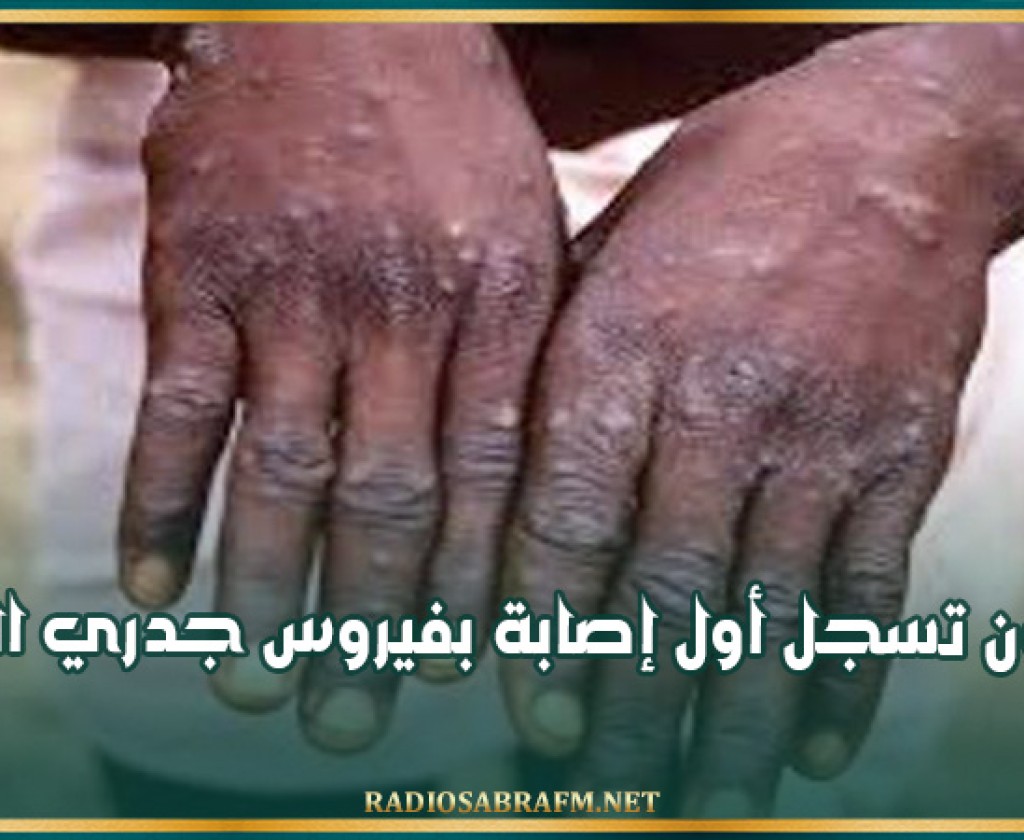 الغابون تسجل أول إصابة بفيروس جدري القردة