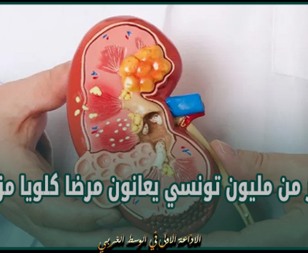 أستاذ في أمراض الكلى: أكثر من مليون تونسي يعانون مرضا كلويا مزمنا وصيامهم يستوجب اتباع تعليمات غذائية محدّدة