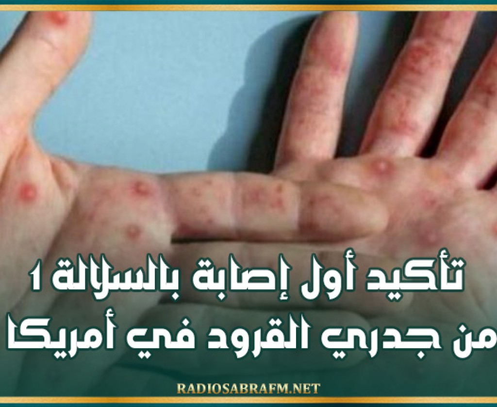 تأكيد أول إصابة بالسلالة 1 من جدري القرود في أمريكا