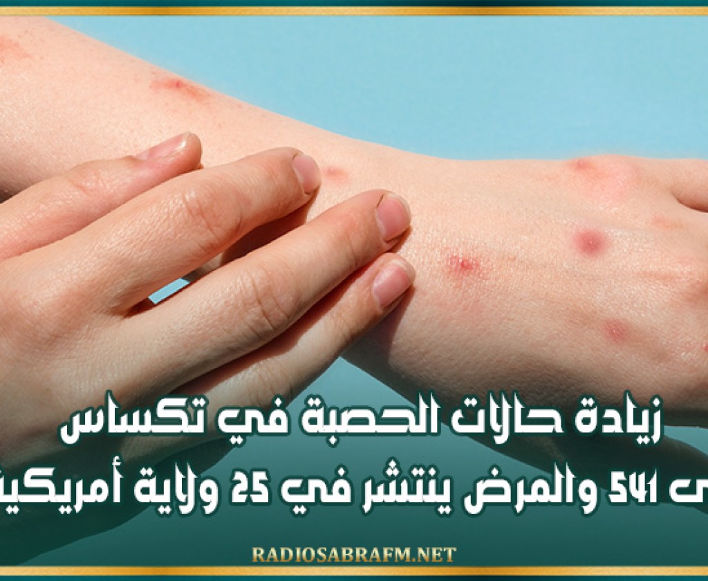 زيادة حالات الحصبة في تكساس إلى 541 والمرض ينتشر في 25 ولاية أمريكية