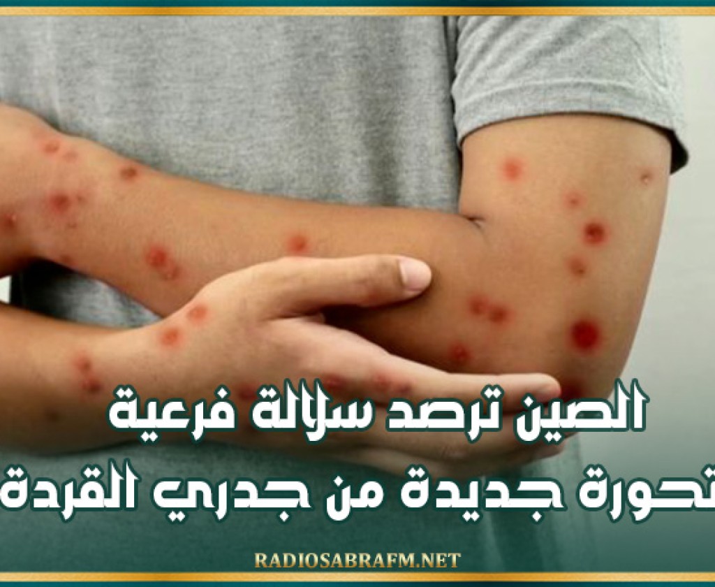 الصين ترصد سلالة فرعية متحورة جديدة من جدري القردة