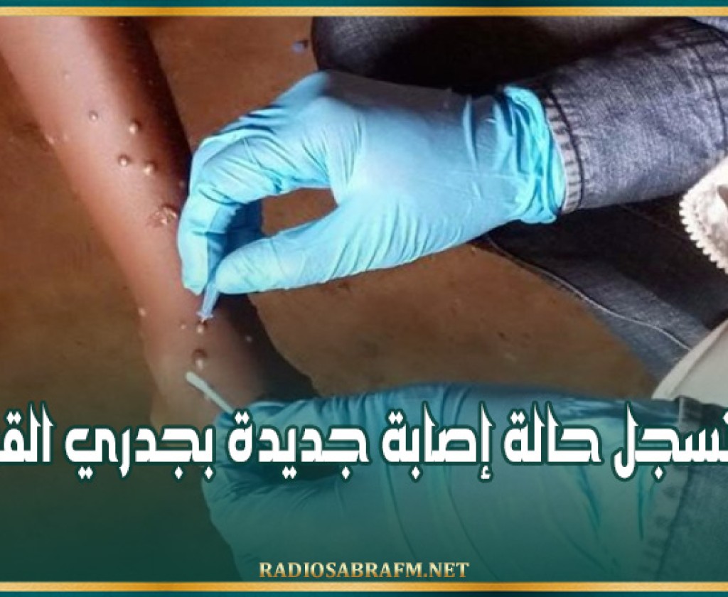غانا تسجل حالة إصابة جديدة بجدري القردة