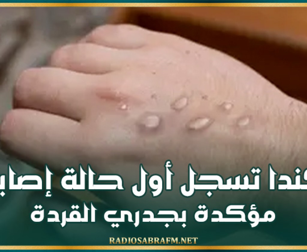 كندا تسجل أول حالة إصابة مؤكدة بجدري القردة