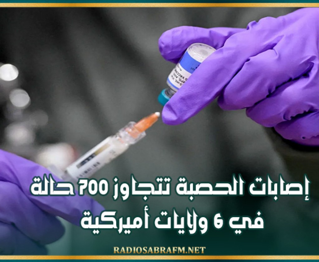 إصابات الحصبة تتجاوز 700 حالة في 6 ولايات أميركية
