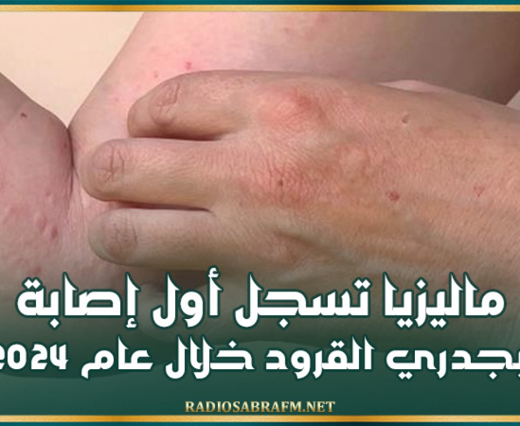 ماليزيا تسجل أول إصابة بجدري القرود خلال عام 2024
