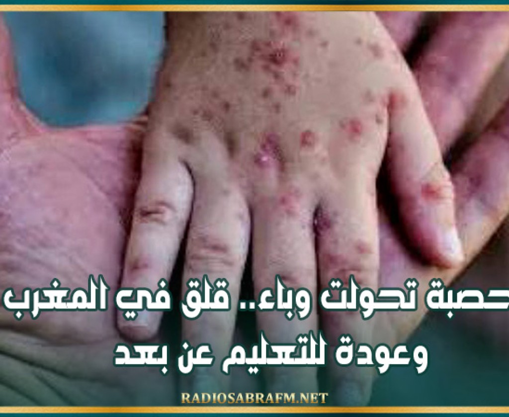 الحصبة تحولت وباء.. قلق في المغرب وعودة للتعليم عن بعد