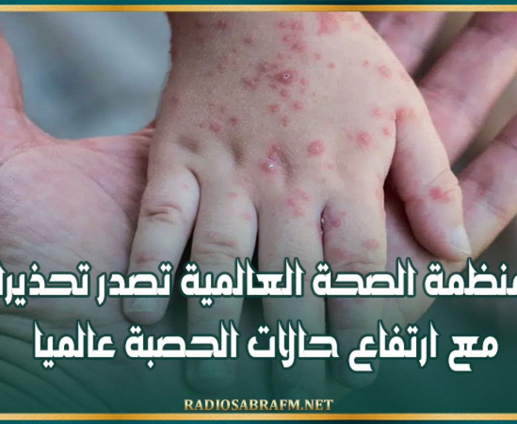 منظمة الصحة العالمية تصدر تحذيرا مع ارتفاع حالات الحصبة عالميا