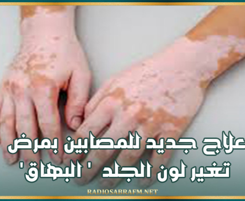 علاج جديد للمصابين بمرض تغير لون الجلد ' البهاق '