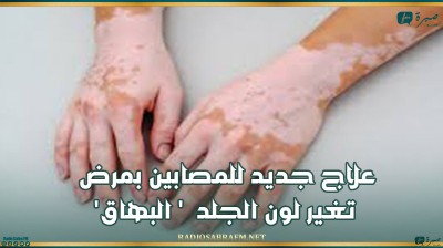 علاج جديد للمصابين بمرض تغير لون الجلد ' البهاق '